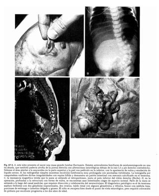CLINICA QUIRURGICA - Cirugia pediatrica   ashcraft