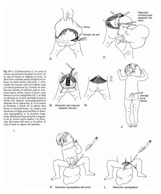 CLINICA QUIRURGICA - Cirugia pediatrica   ashcraft