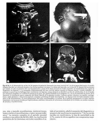 CLINICA QUIRURGICA - Cirugia pediatrica   ashcraft