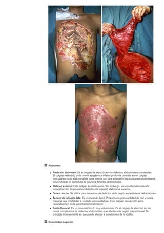 Abdomen:
q Recto del abdomen: Es el colgajo de elección en los defectos abdominales unilaterales.
El colgajo extendido de la arteria epigástrica inferior profunda consiste en un colgajo
miocutáneo recto abdominal de base inferior con una extensión fasciocutánea superolateral.
Está indicado en cobertura de grandes defectos abdominales.
q Oblicuo externo: Este colgajo se utiliza poco. Sin embargo, es una alternativa para la
reconstrucción de pequeños defectos de la pared abdominal superior.
q Dorsal ancho: Se utiliza para cobertura de defectos de la región superolateral del abdomen.
q Tensor de la fascia lata: Es un músculo tipo I. Proporciona gran cantidad de piel y fascia
con una baja morbilidad a nivel de la zona dadora. Es el colgajo de elección en la
reconstrucción de la pared abdominal inferior.
q Recto femoral: Es un músculo tipo II, muy voluminoso. Es el colgajo de elección en los
casos complicados de defectos abdominales que afectan a la región preperitoneal. Su
principal inconveniente es que puede afectar a la extensión de la rodilla.
Extremidad superior
 