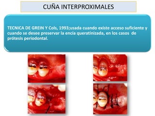 Cirugia Pre Protesica Final