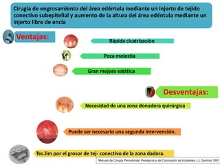 Cirugia Pre Protesica Final