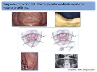 Cirugia Pre Protesica Final