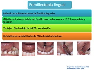 Cirugia Pre Protesica Final