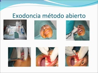 Exodoncia método abierto 