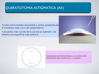 QUERATOTOMIA ASTIGMATICA (AK)
•Cortes transversales arqueados o rectos perpendiculares
al meridiano más curvo del astigmatismo
•Las partes más curvas de la cornea se aplanan y se
obtiene una superficie más esférica
INCISIONES MICROSCOPICAS A LO LARGO DEL
MERIDIANO MAS CURVO DE LA CORNEA
 