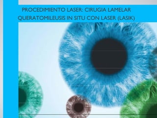 PROCEDIMIENTO LASER: CIRUGIA LAMELAR
QUERATOMILEUSIS IN SITU CON LASER (LASIK)
 