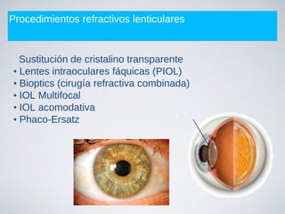 Procedimientos refractivos lenticulares
Sustitución de cristalino transparente
• Lentes intraoculares fáquicas (PIOL)
• Bioptics (cirugía refractiva combinada)
• IOL Multifocal
• IOL acomodativa
• Phaco-Ersatz
 