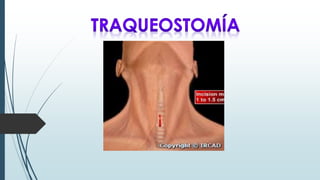 ¿Que es la Traqueostomía?
La traqueostomía es la incisión quirúrgica que se realiza de manera
electiva en la cara anterior...