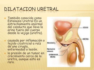 DILATACION URETRAL
   También conocida como
    Estenosis Uretral Es un
    estrechamiento anormal
    del conducto que l...
