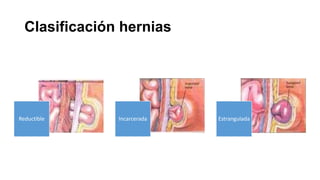 Clasificación hernias
Reductible Incarcerada Estrangulada
 