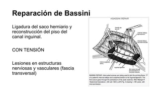Reparación de Bassini
Ligadura del saco herniario y
reconstrucción del piso del
canal inguinal.
CON TENSIÓN
Lesiones en estructuras
nerviosas y vasculares (fascia
transversal)
 