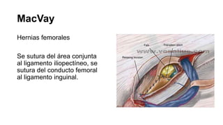 MacVay
Hernias femorales
Se sutura del área conjunta
al ligamento iliopectíneo, se
sutura del conducto femoral
al ligamento inguinal.
 