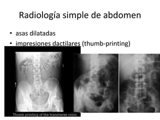 Radiología simple de abdomen
• asas dilatadas
• impresiones dactilares (thumb-printing)

 