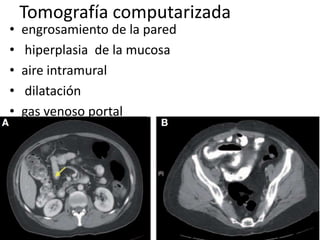 •
•
•
•
•

Tomografía computarizada
engrosamiento de la pared
hiperplasia de la mucosa
aire intramural
dilatación
gas venoso portal

 
