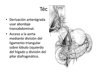 Técnica
• Derivación anterógrada
usar abordaje
transabdominal.
• Acceso a la aorta
mediante división del
ligamento triangular
sobre lóbulo izquierdo
del hígado y división del
pilar diafragmático.

 