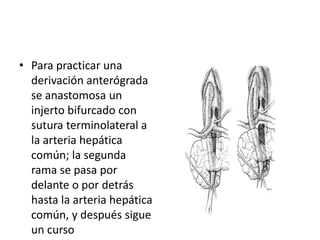 • Para practicar una
derivación anterógrada
se anastomosa un
injerto bifurcado con
sutura terminolateral a
la arteria hepática
común; la segunda
rama se pasa por
delante o por detrás
hasta la arteria hepática
común, y después sigue
un curso

 