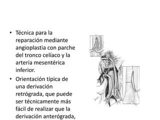 • Técnica para la
reparación mediante
angioplastia con parche
del tronco celíaco y la
arteria mesentérica
inferior.
• Orientación típica de
una derivación
retrógrada, que puede
ser técnicamente más
fácil de realizar que la
derivación anterógrada,

 