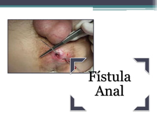 Ginecolosgista faz cirurgia de fistula anal