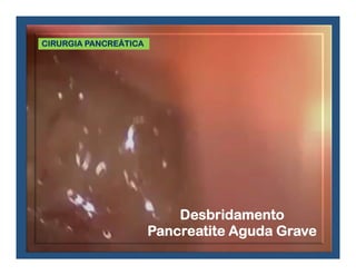Cirurgia Laparoscópica no Adenocarcinoma de Pâncreas
