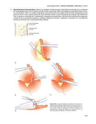 Arlindo Ugulino Netto – CIRURGIA ABDOMINAL– MEDICINA P7 – 2010.2
109
 Apendicectomia laparoscópica: oferece a vantagem da laparoscopia diagnóstica combinada com o potencial
de recuperação mais curta e incisões que são menos conspícuas. Após uma injeção do anestésico local, coloca-
se uma porta de 10mm no umbigo, seguida de uma porta de 5mm na região da linha média suprapúbica e uma
porta de 5mm a meio caminho entre as duas primeiras portas e para a esquerda do músculo reto abdominal.
Com o paciente na posição de Trendelenburg, esquadra-se suavemente o íleo terminal medialmente e seguimos
a tênia do ceco caudal para localizar o apêndice. Depois de retirado, o apêndice é colocado em uma bolsa de
amostra e removido com a porta pela ferida umbilical.
 