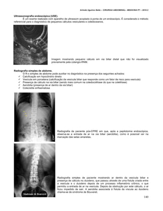 Arlindo Ugulino Netto – CIRURGIA ABDOMINAL– MEDICINA P7 – 2010.2
140
Ultrassonografia endoscópica (USE).
É um exame realizado com aparelho de ultrassom acoplado à ponta de um endoscópio. É considerado o método
referencial para o diagnóstico de pequenos cálculos vesiculares e coledoceanos.
Imagem mostrando pequeno cálculo em via biliar distal que não foi visualizado
previamente pela colangio-RNM.
Radiografia simples de abdome.
O R-x simples de abdome pode auxiliar no diagnóstico na presença dos seguintes achados:
 Calcificação em hipocôndrio direito
 Vesícula em porcelana (calcificação da vesícula biliar que responde como um fator de risco para vesícula)
 Presença de cálculo na via biliar (sendo mais comum na coledocolitíase do que na colelitíase)
 Aerobilia (presença de ar dentro da via biliar)
 Colecistite enfisematosa
Radiografia de paciente pós-CPRE em que, após a papilotomia endoscópica,
observa-se a entrada de ar na via biliar (aerobilia), como é possível ver na
marcação das setas amarelas.
Radiografia simples de paciente mostrando ar dentro da vesícula biliar e
presença de cálculo no duodeno, que passou através de uma fístula criada entre
a vesícula e o duodeno depois de um processo inflamatório crônico, o que
permitiu a entrada de ar na vesícula. Depois da obstrução por este cálculo, o ar
ficou impedido de sair. A aerobilia associada à fístula da víscula ao duodeno
chama-se de síndrome de Bouveret.
 