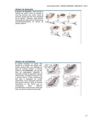 Arlindo Ugulino Netto – CIRURGIA ABDOMINAL– MEDICINA P7 – 2010.2
27
TÉCNICA DE SHOULDICE
A técnica de Shouldice, desenvolvida no
hospital de mesmo nome no Canad†, ‚
uma das t‚cnicas com menor „ndice de
recidivas, por‚m uma das mais complexas
de se realizar. Utiliza-se, nesta t‚cnica,
imbrica€•o de quatro planos de estruturas
mŠsculo-aponeur‡ticas no refor€o da
parede posterior.
TÉCNICA DE LICHTENSTEIN
A grande revolu€•o no reparo das
h‚rnias foi a ado€•o dos reparos sem
tens•o (tension free), com utiliza€•o de
telas de material sint‚tico. A t‚cnica
padr•o ‚ a de Lichtenstein , em que tela
feita de polipropileno (M†rlex–) ‚
suturada ao longo do ligamento inguinal
inferiormente, no tend•o conjunto e sob
o obl„quo interno. ˆ feita a abertura da
tela para a passagem do cord•o
esperm†tico, que ‚ “abra€ado” pela tela.
Esta t‚cnica mostrou „ndice de recidiva
semelhante ou at‚ menor que os
conseguidos pelos melhores
procedimentos convencionais, ainda que
seja uma t‚cnica simples de execu€•o.
 