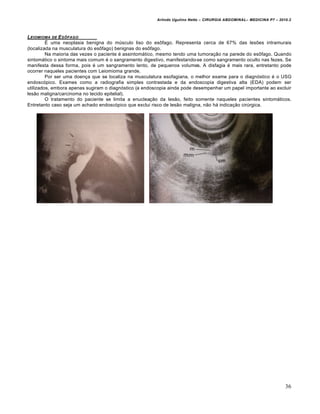Arlindo Ugulino Netto – CIRURGIA ABDOMINAL– MEDICINA P7 – 2010.2
36
LEIOMIOMA DE ESƒFAGO
É uma neoplasia benigna do músculo liso do esôfago. Representa cerca de 67% das lesões intramurais
(localizada na musculatura do esôfago) benignas do esôfago.
Na maioria das vezes o paciente é assintomático, mesmo tendo uma tumoração na parede do esôfago. Quando
sintomático o sintoma mais comum é o sangramento digestivo, manifestando-se como sangramento oculto nas fezes. Se
manifesta dessa forma, pois é um sangramento lento, de pequenos volumes. A disfagia é mais rara, entretanto pode
ocorrer naqueles pacientes com Leiomioma grande.
Por ser uma doença que se localiza na musculatura esofagiana, o melhor exame para o diagnóstico é o USG
endoscópico. Exames como a radiografia simples contrastada e da endoscopia digestiva alta (EDA) podem ser
utilizados, embora apenas sugiram o diagnóstico (a endoscopia ainda pode desempenhar um papel importante ao excluir
lesão maligna/carcinoma no tecido epitelial).
O tratamento do paciente se limita a enucleação da lesão, feito somente naqueles pacientes sintomáticos.
Entretanto caso seja um achado endoscópico que exclui risco de lesão maligna, não há indicação cirúrgica.
 