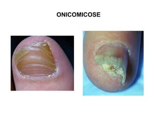ONICOMICOSE
 
