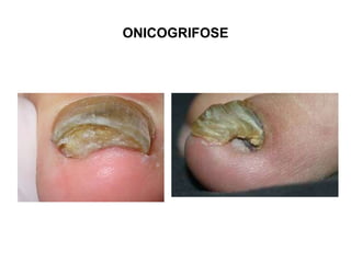 ONICOGRIFOSE
 