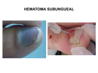 HEMATOMA SUBUNGUEAL
 