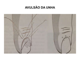 AVULSÃO DA UNHA
 