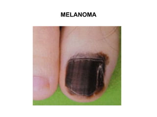 MELANOMA
 