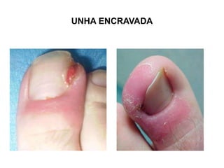 UNHA ENCRAVADA
 