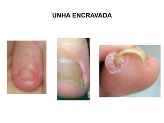 UNHA ENCRAVADA
 