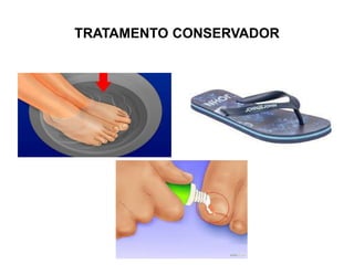 TRATAMENTO CONSERVADOR
 