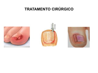 TRATAMENTO CIRÚRGICO
 