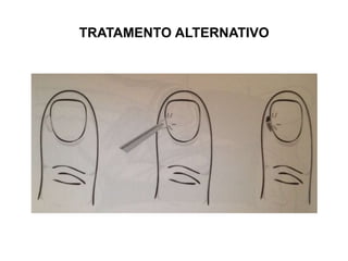 TRATAMENTO ALTERNATIVO
 