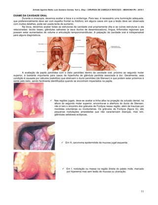 Arlindo Ugulino Netto; Luiz Gustavo Correia; Yuri L. Eloy – CIRURGIA DE CABE•A E PESCO•O – MEDICINA P6 – 2010.1
11
EXAME DA CAVIDADE ORAL
Durante a oroscopia, devemos avaliar a boca e a orofaringe. Para isso, é necessário uma iluminação adequada,
que preferencialmente deve ser com espelho frontal ou fotóforo; em alguns casos em que a lesão deve ser observada
com muitos detalhes, pode ser usada lente de aumento.
Na boca, devemos avaliar todas as estruturas da cavidade oral propriamente dita e as outras estruturas a ela
relacionadas: tecido ósseo, glândulas salivares (e seus ductos de desembocadura), língua, linfonodos regionais que
possam estar aumentados de volume e articulação temporomandibular. A palpação da cavidade oral é indispensável
para alguns diagnósticos.
A avaliação da papila parotídea com o óstio parotídeo dentro da cavidade oral, próximo ao segundo molar
superior, é bastante importante para casos de hipertrofia de glândula parótida associada à dor. Geralmente, esta
condição é causada por cálculos (sialolitos) que obstruem o ducto parotídeo (de Stensen) e que podem estar próximos à
saída pelo óstio, sendo facilmente identificados quando se encontram impactados na papila.
 Nas regiões jugais, deve-se avaliar a linha alba na projeção da oclusão dental; na
altura do segundo molar superior, encontra-se a abertura do ducto de Stensen;
não é raro o encontro dos grânulos de Fordyce nessa região, além de traumas por
mordidas voluntárias ou involuntárias. Os grânulos de Fordyce (figura G), são
pequenas nodulações amareladas que não caracterizam doenças, mas sim,
glândulas sebáceas ectópicas.
 Em H, carcinoma epidermóide da mucosa jugal esquerda.
 Em I, nodulação ou massa na região direita do palato mole, marcado
por hiperemia mas sem lesão de mucosa ou ulceração.
 