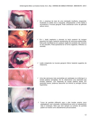 Arlindo Ugulino Netto; Luiz Gustavo Correia; Yuri L. Eloy – CIRURGIA DE CABE•A E PESCO•O – MEDICINA P6 – 2010.1
12
 Em J, presença de mais de uma nodulação insuflante, enegrecida,
localizada no palato duro à esquerda, ultrapassando a linha média e
acometendo a mucosa gengival. Pode caracterizar tumor de glândula
salivar menor.
 Em L, lesão vegetante e ulcerada no terço posterior da margem
esquerda da língua, bastante característica de carcinoma epidermóide.
Este pode manifestar-se em qualquer região da cavidade oral, inclusive
no seu assoalho. Pode apresentar-se na forma vegetante, infiltrativa ou
ulcerada.
 Lesão enegrecida na mucosa gengival inferior bastante sugestiva de
melanoma.
 Uma das estruturas mais acometidas por patologias na orofaringe é a
tonsila palatina (amígdala). Em N, observamos uma assimetria das
tonsilas palatinas, com hipertrofia da tonsila palatina direita. Em
pacientes jovens, podemos desconfiar de linfoma ou laringite crônica
hipertrófica.
 Tumor de parótida infiltrando para o pilar tonsilar anterior (arco
palatoglosso), sem ulceração, manifestando-se como um abaulamento
visto à oroscopia. Note que nem sempre os tumores da parótida
podem se mostrar como abaulamentos pré-auriculares.
 