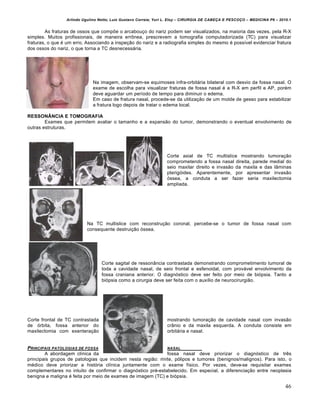 Arlindo Ugulino Netto; Luiz Gustavo Correia; Yuri L. Eloy – CIRURGIA DE CABE•A E PESCO•O – MEDICINA P6 – 2010.1
46
As fraturas de ossos que compõe o arcabouço do nariz podem ser visualizados, na maioria das vezes, pela R-X
simples. Muitos profissionais, de maneira errônea, prescrevem a tomografia computadorizada (TC) para visualizar
fraturas, o que é um erro. Associando a inspeção do nariz e a radiografia simples do mesmo é possível evidenciar fratura
dos ossos do nariz, o que torna a TC desnecessária.
Na imagem, observam-se equimoses infra-orbitária bilateral com desvio da fossa nasal. O
exame de escolha para visualizar fraturas de fossa nasal é a R-X em perfil e AP, porém
deve aguardar um período de tempo para diminuir o edema.
Em caso de fratura nasal, procede-se da utilização de um molde de gesso para estabilizar
a fratura logo depois de tratar o edema local.
RESSONÂNCIA E TOMOGRAFIA
Exames que permitem avaliar o tamanho e a expansão do tumor, demonstrando o eventual envolvimento de
outras estruturas.
Corte axial de TC multislice mostrando tumoração
comprometendo a fossa nasal direita, parede medial do
seio maxilar direito e invasão da maxila e das lâminas
pterigóides. Aparentemente, por apresentar invasão
óssea, a conduta a ser fazer seria maxilectomia
ampliada.
Na TC multislice com reconstrução coronal, percebe-se o tumor de fossa nasal com
consequente destruição óssea.
Corte sagital de ressonância contrastada demonstrando comprometimento tumoral de
toda a cavidade nasal, de seio frontal e esfenoidal, com provável envolvimento da
fossa craniana anterior. O diagnóstico deve ser feito por meio de biópsia. Tanto a
biópsia como a cirurgia deve ser feita com o auxílio de neurocirurgião.
Corte frontal de TC contrastada mostrando tumoração de cavidade nasal com invasão
de órbita, fossa anterior do crânio e da maxila esquerda. A conduta consiste em
maxilectomia com exenteração orbitária e nasal.
PRINCIPAIS PATOLOGIAS DE FOSSA NASAL
A abordagem clínica da fossa nasal deve priorizar o diagnóstico de três
principais grupos de patologias que incidem nesta região: rinite, pólipos e tumores (benignos/malignos). Para isto, o
médico deve priorizar a história clínica juntamente com o exame físico. Por vezes, deve-se requisitar exames
complementares no intuito de confirmar o diagnóstico pré-estabelecido. Em especial, a diferenciação entre neoplasia
benigna e maligna é feita por meio de exames de imagem (TC) e biópsia.
 
