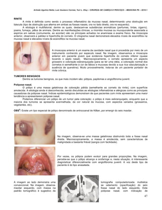 Arlindo Ugulino Netto; Luiz Gustavo Correia; Yuri L. Eloy – CIRURGIA DE CABE•A E PESCO•O – MEDICINA P6 – 2010.1
47
RINITE
A rinite é definida como sendo o processo inflamatório da mucosa nasal, determinando uma obstrução em
báscula (tipo de obstrução que alterna em ambas as fossas nasais, ora no lado direito, ora no esquerdo).
A etiologia é multifatorial, dentre os quais, destacam-se substâncias aromáticas (perfumes, tintas, cigarro),
poeira, fumaça, pêlos de animais. Dentre as manifestações clínicas, a rinorréia mucosa ou mucopurulenta associada a
espirros em salvas (comumente, ao acordar) são os principais achados na anamnese e exame físico. Na rinoscopia
anterior, observará a palidez e hipertrofia do corneto. O citograma nasal demonstrará elevados níveis de eosinófilos na
mucosa nasal e elevados níveis de eosinófilos na mucosa nasal.
A rinoscopia anterior é um exame da cavidade nasal que é procedida por meio de um
instrumento conhecido por especulo nasal. Na imagem, observamos a rinoscopia
anterior em paciente jovem que evidencia hipertrofia do corneto inferior (quase
tocando o septo nasal). Macroscopicamente, o corneto apresenta um aspecto
grosseiro e coloração esbranquiçada (para se ter uma idéia, a coloração normal dos
cornetos é semelhante à cor de lábios e mucosas devido a sua rica vascularização e
ausência de queratina). Muito provavelmente, trata-se de um paciente portador de
rinite crônica.
TUMORES BENIGNOS
Dentre os tumores benignos, os que mais incidem são: pólipos, papilomas e angiofibroma juvenil.
Polipose nasal.
O pólipo é uma massa gelatinosa de coloração pálida (semelhante ao corneto da rinite), com superfície
amolecida. A etiologia ainda é desconhecida, sendo discutidas as etiologias inflamatórias e alérgicas como as principais
causadoras da polipose nasal. Índices epidemiológicos demonstram de que pacientes com rinite apresentam uma maior
tendência a apresentarem polipose nasal.
Podemos diferenciar um pólipo de um tumor pela coloração: o pólipo é mais esbranquiçado, enquanto que a
maioria dos tumores se apresenta avermelhada, da cor natural da mucosa, com aspectos variados (grosseiros,
vegetantes, etc).
OBS
5
: Existe um tipo especial de pólipo denominado de antrocoanal de Killian, por emergir do seio maxilar.
Na imagem, observa-se uma massa gelatinosa obstruindo toda a fossa nasal
direita. Macroscopicamente, a massa é amolecida, sem características de
malignidade e bastante friável (sangra com facilidade).
Por vezes, os pólipos podem evoluir para grandes proporções. Na imagem,
percebe-se que o pólipo alcança a orofaringe e, nesta situação, é interessante
diagnósticar diferencialmente com angiofibroma juvenil. A voz deste tipo de
paciente é do tipo anasalada.
A imagem ao lado demonstra uma tomografia computadorizada multislice
convencional. Na imagem, observa- se velamento (opacificação) do seio
maxilar esquerdo, com massa na fossa nasal do lado esquerdo. Este
padrão tomográfico é sugestivo de polipose nasal, com indicação de
 