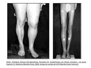 Fonte: Trombose Venosa Pós-Operatória, Piccinato CE. Fundamentos em Clinica Cirúrgica – 2a parte,
Capitulo VI. Medicina Ribeirão Preto, 2008. (artigo de revisão da USP Ribeirão Preto/ internet).
 