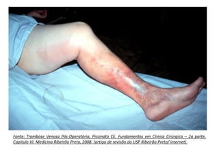 Fonte: Trombose Venosa Pós-Operatória, Piccinato CE. Fundamentos em Clinica Cirúrgica – 2a parte,
Capitulo VI. Medicina Ribeirão Preto, 2008. (artigo de revisão da USP Ribeirão Preto/ internet).
 
