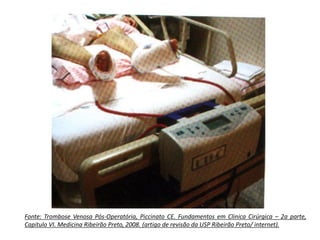 Fonte: Trombose Venosa Pós-Operatória, Piccinato CE. Fundamentos em Clinica Cirúrgica – 2a parte,
Capitulo VI. Medicina Ribeirão Preto, 2008. (artigo de revisão da USP Ribeirão Preto/ internet).
 