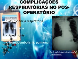 COMPLICAÇÕES
RESPIRATÓRIAS NO PÓS-
OPERATÓRIO
• Insuficiência respiratória
• Atelectasia
• Pneumonia
• Tromboembolismo pulmonar
Fonte:galeria.sld.cu/main.php?g2
_itemId=48670
 