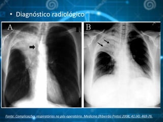 • Diagnóstico radiológico
Fonte: Complicações respiratórias no pós-operatório. Medicina (Ribeirão Preto) 2008; 41 (4): 469-76.
 