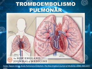 TROMBOEMBOLISMO
PULMONAR
Fonte: Tapson Victor. Acute Pulmonary Embolism. The New England Journal of Medicine. 2008; 358:1037-
 