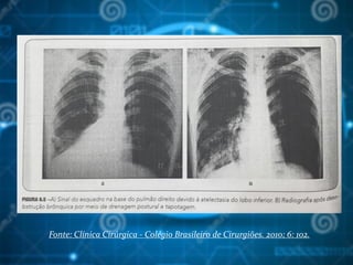 Fonte: Clínica Cirúrgica - Colégio Brasileiro de Cirurgiões. 2010; 6: 102.
 