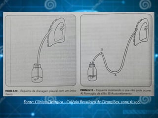 Fonte: Clínica Cirúrgica - Colégio Brasileiro de Cirurgiões. 2010; 6: 106.
 